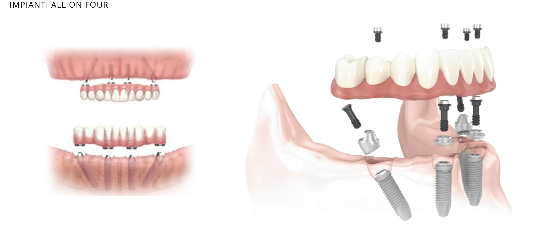 Имплантация зубов all on 4. Имплантация зубов по технологии «all on 4». All on 4 имплантация Нобель.